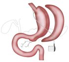 Endostim